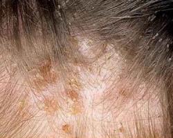 Bedbug koduma simptomi uz cilvēka ādas